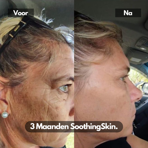 SoothingSkin Micro infuus systeem