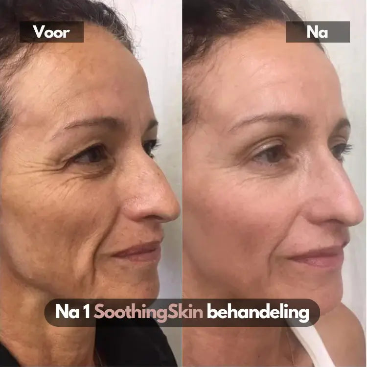 SoothingSkin Micro infuus systeem